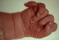 Patau Syndrome Patau (8).jpg